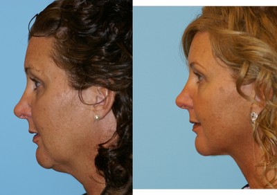 Rhytidectomy - 
	This patient complained about her excess tissue under her chin and jowl. She had a facelift to sharpen her neckline and reveal her natural jawline.
