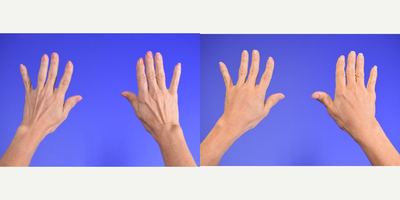 Hand rejuvenation - 60 year old woman treated with Radiesse (filler) for hand rejuvenation