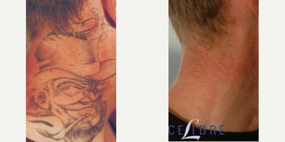 Complete laser tattoo removal in Los Angeles - Is complete tattoo removal possible? Absolutely! You just need the right laser technology - multiple wavelengths of q-switched lasers and a fractional laser as well.