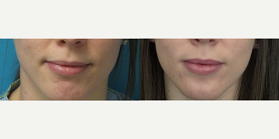 27 year old woman treated with Volbella - This patient desired fuller lips