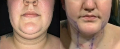 Woman treated with Vaser Liposuction - Woman treated with Vaser Liposuction