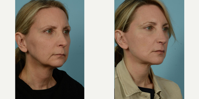45-54 year old woman treated with Facelift, Lower Facelift, Neck Lift, Facial Fat Transfer, Laser Resurfacing, Dermabrasion - The 54-year-old female patient pictured above was driven by considerable changes of aging, particularly evident in the areas around the jowls and cheeks, thin lips, the early appearance of vertical lines around the mouth, and changes in her neck. This active runner and yoga enthusiast sought out the exceptional Facelift/Minilift by Dr. Mustoe in Chicago, renowned for delivering natural and not overstretched results. The patient was referred by a friend who ten years prior had trusted Dr. Mustoe with a similar surgery.Under IV sedation and local anesthesia, Dr. Mustoe employed a deep plane facelift, fat grafting around the mouth, ablative laser, and spot dermabrasion around the mouth and to her forehead. Her ease throughout the process was likely a result of the widely recognized expertise and care of Dr. Mustoe and his staff at TLKM Plastic Surgery.Post-procedure, the patient's results were dramatically visible in her naturally rejuvenated and fresh appearance. The transformation was balanced, avoiding the appearance of being overstretched, which was crucial for her. Comfort and satisfaction with the Facelift/Minilift by Dr. Mustoe in Chicago was evident in the patient's glowing post-procedure expression, all while retaining the natural characteristics that made her unique. The outcomes bear witness to Dr. Mustoe's excellence, a culmination of over 30 years of experience combined with a prestigious background of education and research from Harvard to advisory positions with the U.S. Food & Drug Administration.
