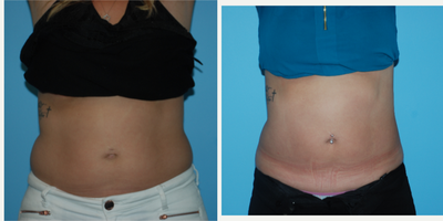 25-34 year old woman treated with SculpSure - Patient had SculpSure only 4 weeks ago that has early improvement of the front of her abdomen. It typically takes 6 to 12 weeks to see a final result