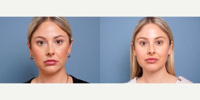 36 year old woman treated with MyEllevate - 36 year old woman treated with MyEllevate with 15 cc liposuction to neck. Photos depict before and 6 weeks after surgery.