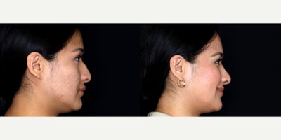 25 year old woman treated with Septoplasty, Rhinoplasty, Dermabrasion - 25 year old woman treated with Septoplasty, Rhinoplasty, Dermabrasion. Photos depict before and 2 months after surgery