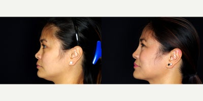 38 year old woman treated with Asian Rhinoplasty. - 38 year old woman treated with Asian Rhinoplasty. Photos depict before and 10 months after surgery.