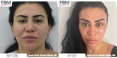 45-54 year old woman treated with Deep Plane Facelift, Neck Lift, Rhinoplasty, Lip Lift, Canthoplasty, Eyelid Surgery, Facial Fa - 45-54 year old woman treated with Deep Plane Facelift, Neck Lift, Rhinoplasty, Lip Lift, Canthoplasty, Eyelid Surgery, Facial Fat Transfer