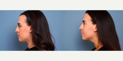 29 year old woman treated with myellevate - 29 year old woman treated with myellevate . Photos depict before and 1 week after surgery
