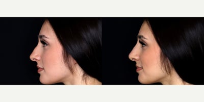 24 year old woman treated with Vollure, Nonsurgical Nose Job - 24 year old woman treated with 0.7 syringe of Vollure, Nonsurgical Nose Job. Photos depict before and immediately after treatment.