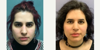 25-34 year old transgender woman treated with Adam's Apple Reduction, Facial Feminization Surgery, Forehead Reduction, Rhinoplas - This is a young lady who underwent FFS with a coronal incision. She is doing well in her recovery.