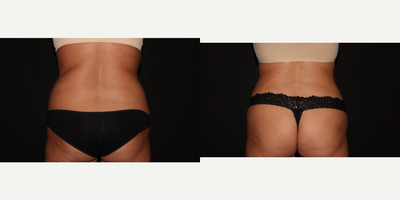 25-34 year old woman treated with Laser Liposuction, Renuvion, Skin Tightening - Liposuction and Renuvion to patients abdomen and flanks.