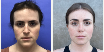 Patient treated with Facial Feminization Surgery, Rhinoplasty, Septoplasty, Transgender Facial Feminization Surgery - 25 to 34 year-old female patient is 3 months post-op from Facial Feminization surgery. Her procedures included: Forehead Lift, Hairline Lowering, Orbital Bony Contouring, Septorhinoplasty (open) with Cartilage Grafts and Weirs, Cheek Implants (small combined), Voluma - 2 cc to Medial Cheeks, Chin Reduction and Contour, Thyroid Cartilage Shave, Intranasal Lip Lift with Fat Augmentation, Soft Tissue to Nasolabial Folds and 300 Micrografts to the Fronto Temporal Recessions.