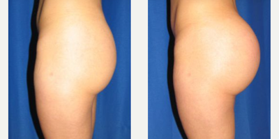 Woman treated with Butt Implants - Woman treated with Butt Implants