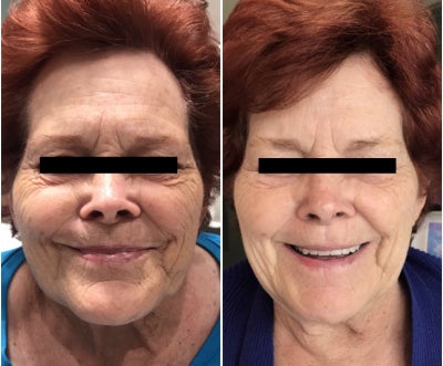 75-85 year old woman treated with Venus Viva - After just 3 treatments with the Venus Viva, this lovely lady is flaunting obvious results! He skin is tighter, smoother, and she looks years younger! She is producing her own collegian and her fine lines and wrinkles are vanishing before our eyes!