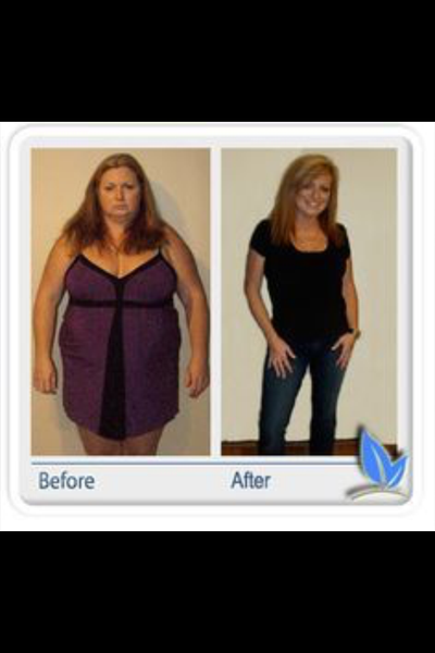 Tijuana Gastric Sleeve Surgery Before and After Photos: Patient