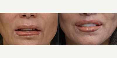 55-64 year old woman treated with Lip Surgery, Lip Lift - depending on the patients needs. This case involved a patient who had previously undergone a direct lower lip lift that resulted in an indented, asymmetrical, and unnatural stuck-on appearance resembling a prosthetic. Tragically, this beautiful woman had lived as a recluse for nearly a decade before being referred to me by a respected local plastic surgeon.Our approach began with meticulous planning, including localized tissue expansion using fillers to optimize the area before considering surgical intervention. The patient sought assurance that any scarring could be effectively minimized. To address her concerns, I performed a combination of procedures: my signature 3-D upper lip lift, medialized corner lip lifts, a lower V-Y advancement, and a precise scar revision of the lower vermilion-cutaneous edge. These techniques helped correct asymmetry and enhance the lower lips natural shape.A well-contoured lower lip isnt just about symmetryit should also elevate to subtly conceal the lower teeth, with a pout focused at its center. While not perfect, the outcome was transformativeimmeasurably better than the original appearance and a step toward restoring the patients confidence and quality of life.