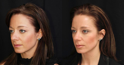 Aesthetic facial balancing - 
	aesthetic facial balancing.
