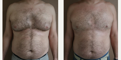 35-44 year old man treated with Gynecomastia Surgery - 2 months postoperative from Gynecomastia surgery with Ultrasonic Liposuction and Renuvion Skin tightening