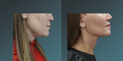 35-44 year old woman treated with Thermage FLX - 35-44 year old woman treated with Thermage FLX