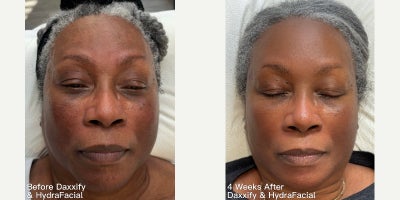 55-64 year old woman treated with Daxxify, HydraFacial - These results are after two HydraFacial treatments and a 4 weeks after Daxxify injections. Clients skin is appears brighter, smoother, and more even in tone, with improved clarity and softness. Results shown after full neurotoxin onset.