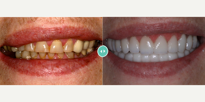 Woman treated with Porcelain Veneers - Woman treated with Porcelain Veneers