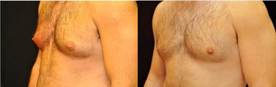 28 Year Old Male treated for Enlarged breasts. 1 Coolsculpting treatment.  - Off-label use. Great Result. One Coolsculpting treatment. No weight change.