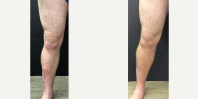 Stasis Dermatitis treated with Varithena - This patient had stasis dermatitis that was vein related, as you can see 1 month post Varithena, phlebectomy, and sclerotherapy, it's gone! Venous reflux doesn't always show itself as bulging, varicose veins. This is a great example of that!
