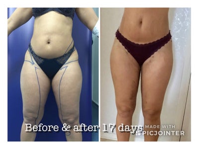 Vaser Lipo In Istanbul With Mcan Health And Dr Hariri Review