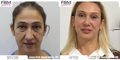 45-54 year old woman treated with Deep Plane Facelift, Neck Lift, Double Eyelid Surgery, Facial Fat Transfer, Brow Lift - 45-54 year old woman treated with Deep Plane Facelift, Neck Lift, Double Eyelid Surgery, Facial Fat Transfer, Brow Lift