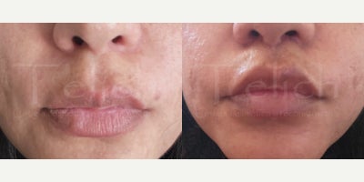 35-44 year old woman treated with Lip Lift, Lip Surgery - 35 year old woman who underwent lip lift under local anesthesia
