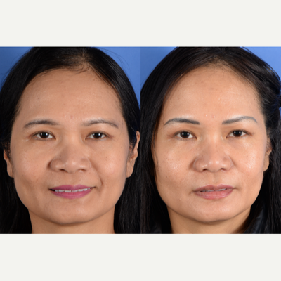 45-54 year old woman treated with Asian Rhinoplasty, Alarplasty - This pleasant woman presented with the goals of reducing her nostrils. Approximately 3-4 mm of nostril was removed on each side. This was performed in clinic and was well-tolerated. Her scars are unnoticeable.