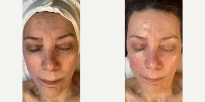Woman treated with HydraFacial - Woman treated with HydraFacial