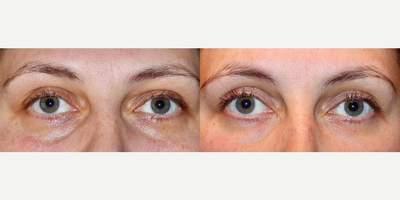 35-44 year old woman treated with Injectable Fillers - Redensity 2 filler