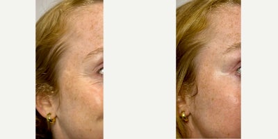 25-34 year old woman treated with Botox - Crows Feet Lines treated with 15 units of Botox