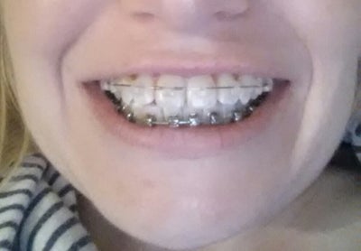 quail rubber bands braces