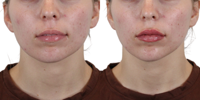 25-34 year old woman treated with Lip Fillers, Dermal Fillers, Restylane, Restylane Defyne, Restylane Refyne, Juvederm - Our expert injector added volume, shape, and definition to the lips to create a natural-looking plump and hydrated effect. Our team is all about enhancing your natural beauty and achieving symmetry, and balance in every treatment. At AdmireMD Skin Clinic, we take pride in our commitment to helping our patients achieve their desired aesthetic outcomes. Our dedicated team works closely with each individual, understanding their unique goals and concerns. We stay updated with the latest techniques in the field to ensure that we bring our patients the best possible results.