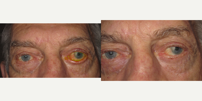 75 and up year old man treated with Eyelid Surgery - Ectropion repair left lower eyelid