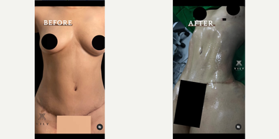 35-44 year old woman treated with Abdominal Etching, Liposuction, Liposculpture, Butt Augmentation, Brazilian Butt Lift - 35-44 year old woman treated with Abdominal Etching, Liposuction, Liposculpture, Butt Augmentation, Brazilian Butt Lift