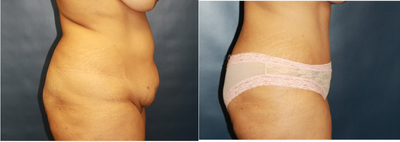Woman treated with Tummy Tuck - Bikini tummy tuck with low scar placement