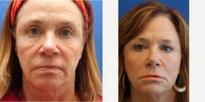 55-64 year old woman treated with Laser Resurfacing - Dr Gulin used this Smartskin for skin rejuvenation which will give this patient a comprehensive treatment that incorporates all layers of aged and sun-damaged skin. This treatment goes deep into the collagen structures of the skin to address some laxity resulting in tighter, smoother skin.