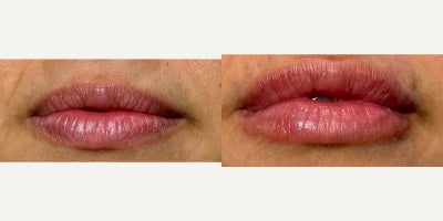 25-34 year old woman treated with Dermal Fillers - Non-Surgical Lip Enhancement with 1 syringe of SkinVive.