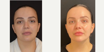 25-34 year old woman treated with CoolMini - Before photos taken 7/1/21 and after photos taken 9/24/21. Used 2 cool minis in one treatment.