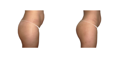 35-44 year old woman treated with Skin Tightening - This patient had derrire but she wanted to lift it up, that can be done with a non surgical treatment.  Gluteos Up is a personalized protocol that increase glutes volume and defined muscle tone in the treated area