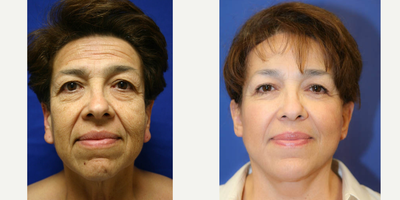 Ear Lobe Surgery (front view) - This is a 61 year old female. She was not happy with the appearance of her face or neck. She underwent a face lift, neck lift, brow lift, upper and lower blepharoplasty and earlobe reduction.