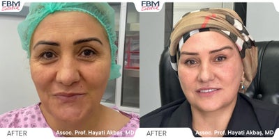 35-44 year old woman treated with Mini Facelift, Double Eyelid Surgery - 35-44 year old woman treated with Mini Facelift, Double Eyelid Surgery