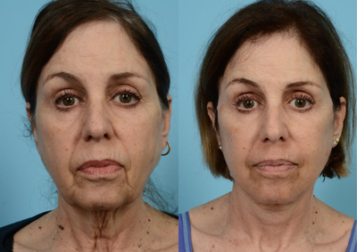 Woman treated with Facial Fat Transfer - 69 year old woman who was an excellent candidate for a lower facelift. She also had some hollowness in her lower eyelids so we decided to proceed with some fat grafting.