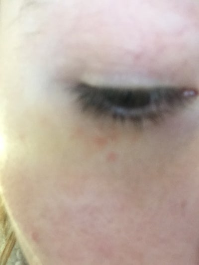 Why do I have these red bumps under my eyelid? Reaction to soap/shampoo ...