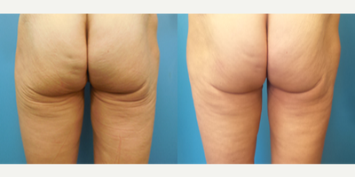 57 year old woman treated with Thermage - This patient was concerned with sagging skin below the buttocks.