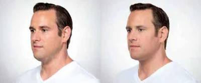 Man treated with Kybella - Man treated with Kybella to chin area, shown before and after 6 treatments.