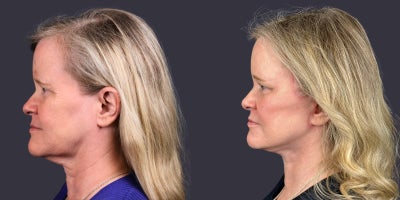 55-64 year old woman treated with ActiveFX, Brow Lift, Facelift, Laser Resurfacing, Lower Facelift, Neck Lift, SMAS Facelift - 56 year old who presented for facial rejuvenation. She is 5'5 and 158 pounds. She had a brow lift, lower face and neck lift, as well as central face CO2 laser skin resurfacing.